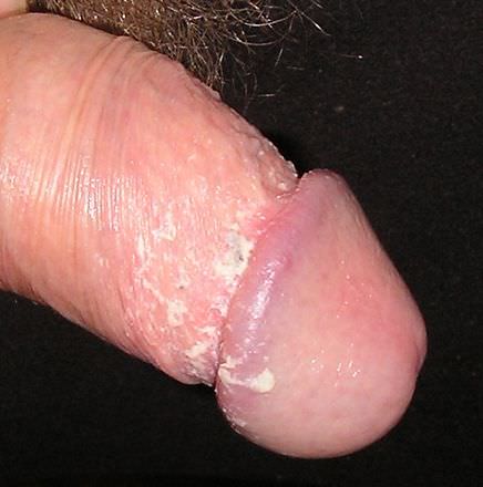 Dyspareunie, pijn bij het vrijen Hier een foto van smegma op de penis waardoor er een ontsteking kan komen