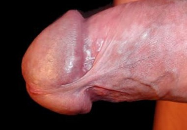 Dyspareunie, pijn bij het vrijen hier het toompje van de penis dat is heel erg gevoelig